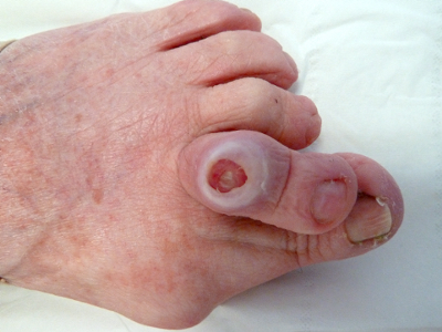 Fungal skin infections the facts | Health | Bupa UK
